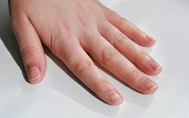 Foto - Tırnaklarınızda beyaz leke varsa dikkat!