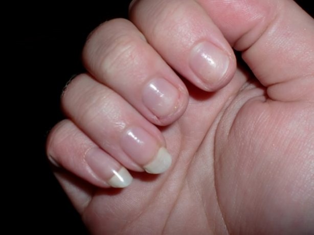 Foto - Tırnaklarınızda beyaz leke varsa dikkat!