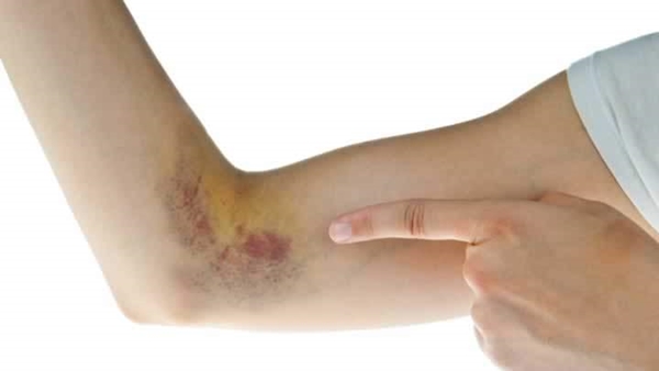 Foto - Tırnaklarınızda beyaz lekeler varsa, dikkat!