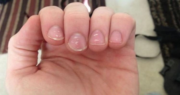 Foto - Tırnaklarınızda beyaz lekeler varsa, dikkat!