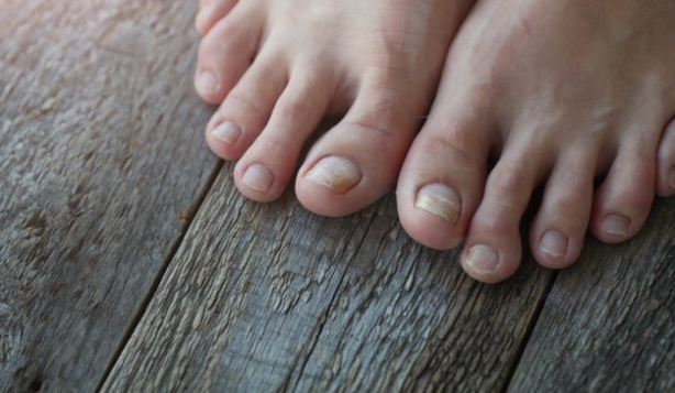 Foto - Tırnaklarınızda bu lekeler varsa dikkat! Hemen hastaneye koşun