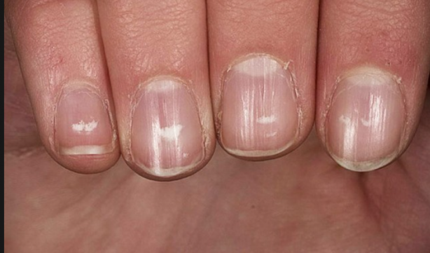 Foto - Tırnaklarınızda bu lekeler varsa dikkat! Hemen hastaneye koşun