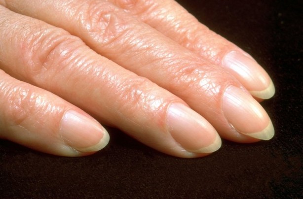 Foto - Tırnaklarınızda bu lekeler varsa dikkat! Hemen hastaneye koşun