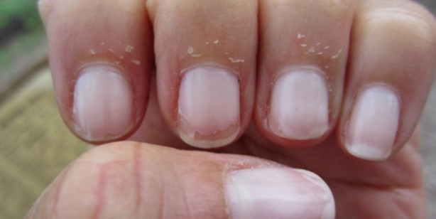 Foto - Tırnaklarınızda bu lekeler varsa dikkat! Hemen hastaneye koşun
