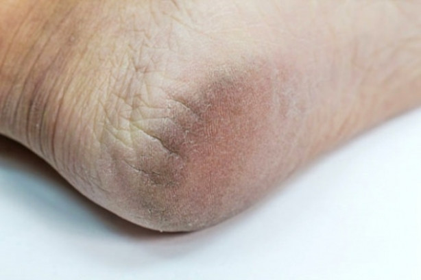 Foto - Topuk çatlakları ölümcül bir hastalığın belirtisi olabilir