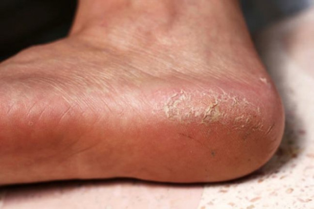 Foto - Topuk çatlakları ölümcül bir hastalığın belirtisi olabilir