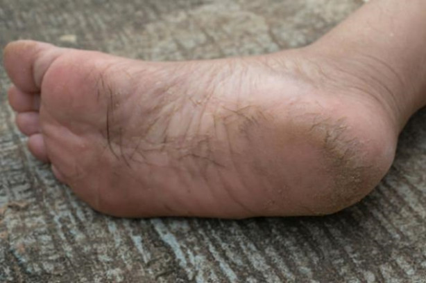 Foto - Topuk çatlakları ölümcül bir hastalığın belirtisi olabilir