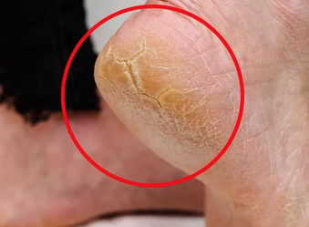 Topuk çatlaklarına 1 gecede elveda: Sertleşmiş ve kurumuş ise anında pamuk gibi yapan maske!