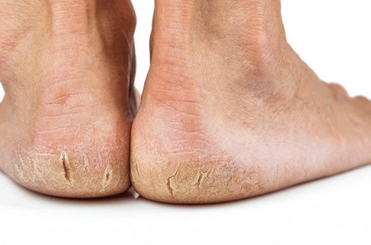 Foto - Topuk çatlaklarına 1 gecede elveda: Sertleşmiş ve kurumuş ise anında pamuk gibi yapan maske!