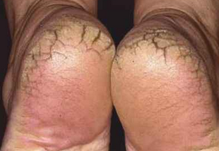 Foto - Topuk çatlaklarına 1 gecede elveda: Sertleşmiş ve kurumuş ise anında pamuk gibi yapan maske!