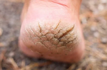 Foto - Topuk çatlaklarına 1 gecede elveda: Sertleşmiş ve kurumuş ise anında pamuk gibi yapan maske!