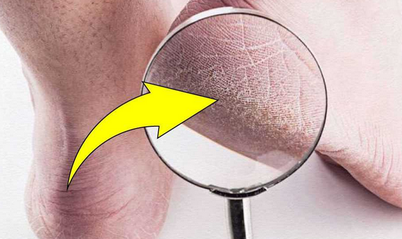 Foto - Topuk çatlaklarına 1 gecede elveda: Sertleşmiş ve kurumuş ise anında pamuk gibi yapan maske!