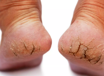 Foto - Topuk çatlaklarına 1 gecede elveda: Sertleşmiş ve kurumuş ise anında pamuk gibi yapan maske!