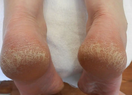 Foto - Topuk çatlaklarına 1 gecede elveda: Sertleşmiş ve kurumuş ise anında pamuk gibi yapan maske!