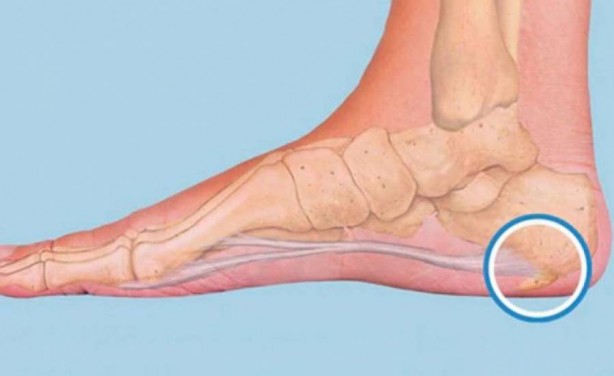 Foto - Topuk dikenine karşı denenmiş doğal yöntemler: Herkes bakın ne yaptı: Çözüm önerileri damgasını vurdu