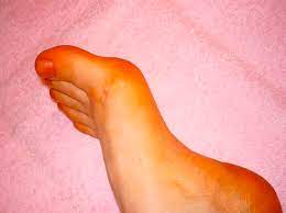 Foto - Topuk dikenine karşı denenmiş doğal yöntemler: Herkes bakın ne yaptı: Çözüm önerileri damgasını vurdu