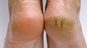 Foto - Topuk dikenine olabilecek en iyi çözüm! Kökünden söküyor... Yumuşacık yapan kür şaşırttı! Bakın ne yapıyor