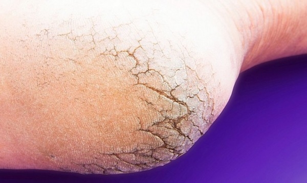 Foto - Topuklarınızdaki çatlaklardan kurtulmak için...