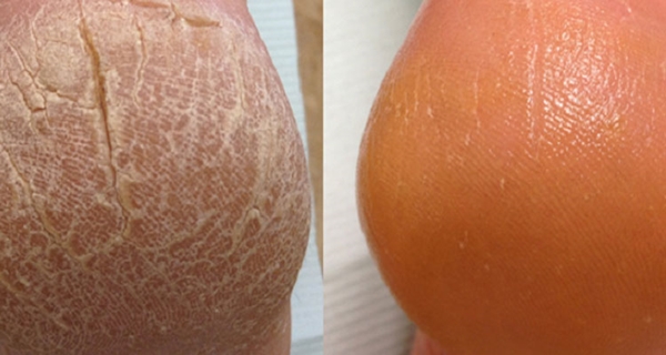 Foto - Topuklarınızdaki çatlaklardan kurtulmak için...