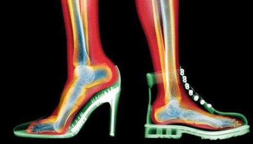 Topuklu alınan ayakkabı sadece bir ayda ayaklara değil, vücuda ciddi zarar veriyor! Uzmanı herkesin son vermesini istedi