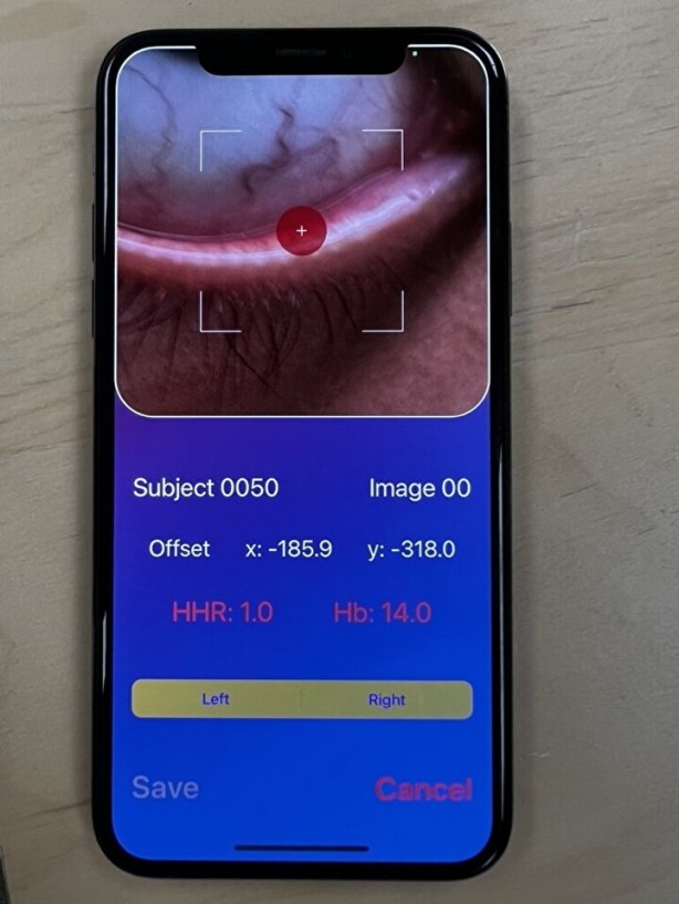 Foto - Türk hekimden müthiş buluş! Kan testi artık tarihe karışacak