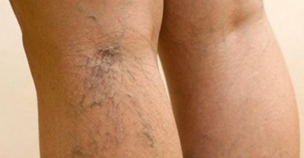 Foto - Türkiye’de her 2 kişiden 1’inde var! Önlem alınmazsa büyük tehlike