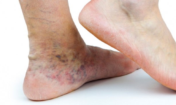 Foto - Türkiye’de her 2 kişiden 1’inde var! Önlem alınmazsa büyük tehlike