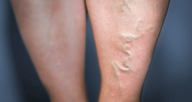 Foto - Türkiye’de her 2 kişiden 1’inde var! Önlem alınmazsa büyük tehlike