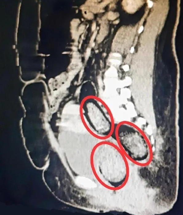 Foto - Türkiye'de idam şart! Kadın yolcunun makatından bakın ne çıktı