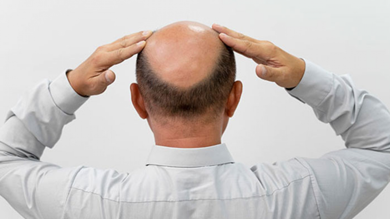 Foto - Türkiye'de saç ekimi turizmine yoğun ilgi: Türkiye'nin dört bir yanında gün boyu ilgi var