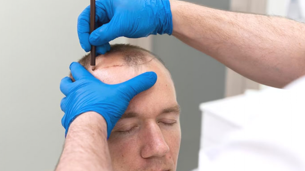 Foto - Türkiye'de saç ekimi turizmine yoğun ilgi: Türkiye'nin dört bir yanında gün boyu ilgi var