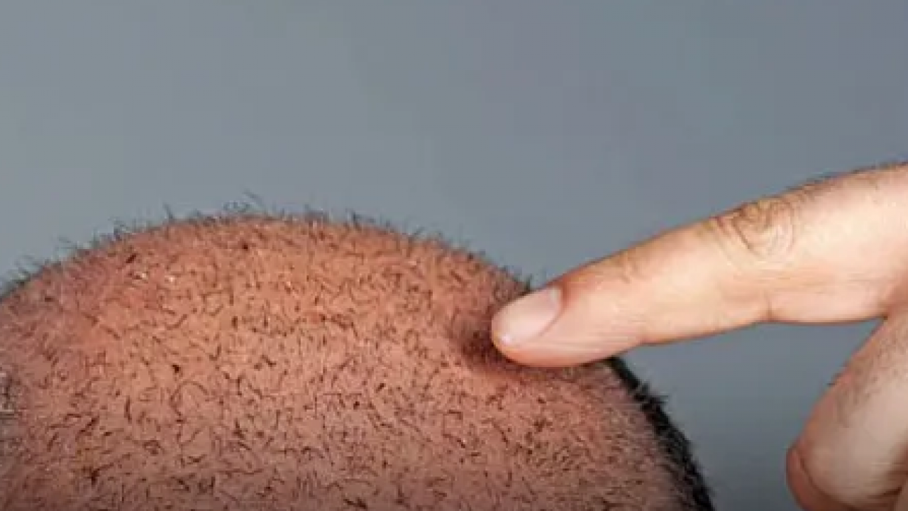 Foto - Türkiye'de saç ekimi turizmine yoğun ilgi: Türkiye'nin dört bir yanında gün boyu ilgi var