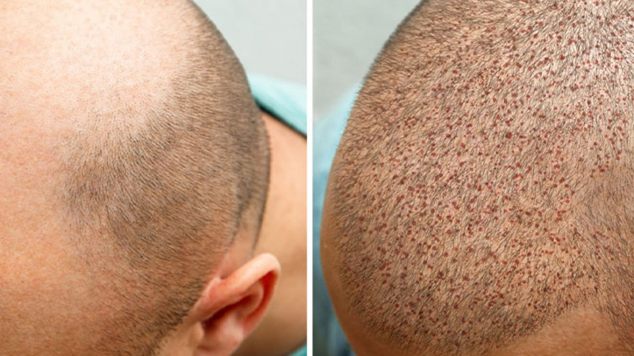 Foto - Türkiye'de saç ekimi turizmine yoğun ilgi: Türkiye'nin dört bir yanında gün boyu ilgi var