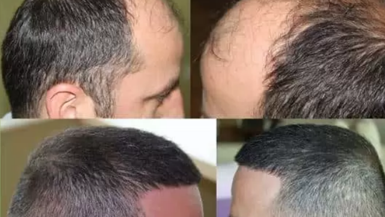 Foto - Türkiye'de saç ekimi turizmine yoğun ilgi: Türkiye'nin dört bir yanında gün boyu ilgi var