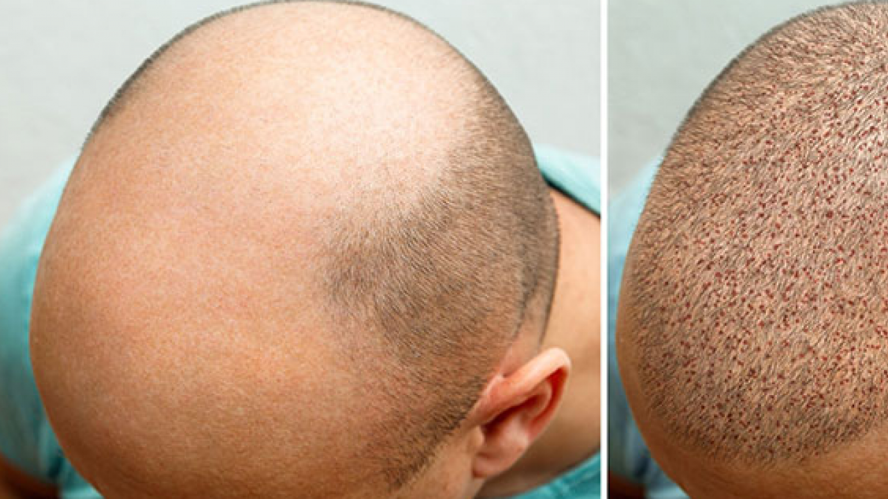 Foto - Türkiye'de saç ekimi turizmine yoğun ilgi: Türkiye'nin dört bir yanında gün boyu ilgi var