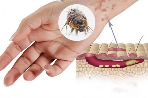 Foto - Türkiye'de uyuz alarmı! 6 ayda pik yaptı, tek çaresi var