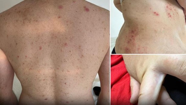 Türkiye'de uyuz alarmı! 6 ayda pik yaptı, tek çaresi var