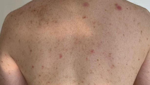 Foto - Türkiye'de uyuz alarmı! 6 ayda pik yaptı, tek çaresi var