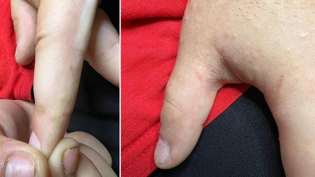 Foto - Türkiye'de uyuz alarmı! 6 ayda pik yaptı, tek çaresi var