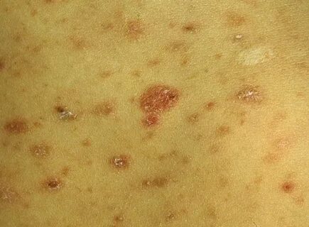 Foto - Türkiye'de uyuz alarmı! 6 ayda pik yaptı, tek çaresi var