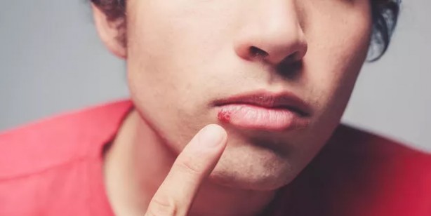 Foto - Uçuğu olan herkes dikkat! Uçuğa dokunmayın: Ölümcül hastalık olabilir