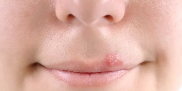 Uçuğu olan herkes dikkat! Uçuğa dokunmayın: Ölümcül hastalık olabilir