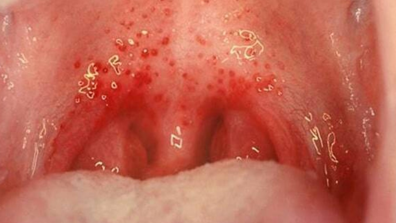 Uçuk virüsü tehlikesi ortaya çıktı! Bilim insanları gerçek bu diyerek duyurdular!