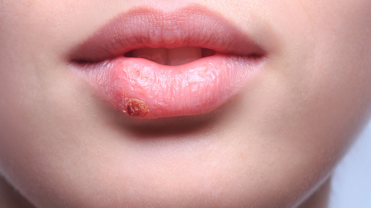 Foto - Uçuk virüsü tehlikesi ortaya çıktı! Bilim insanları gerçek bu diyerek duyurdular!