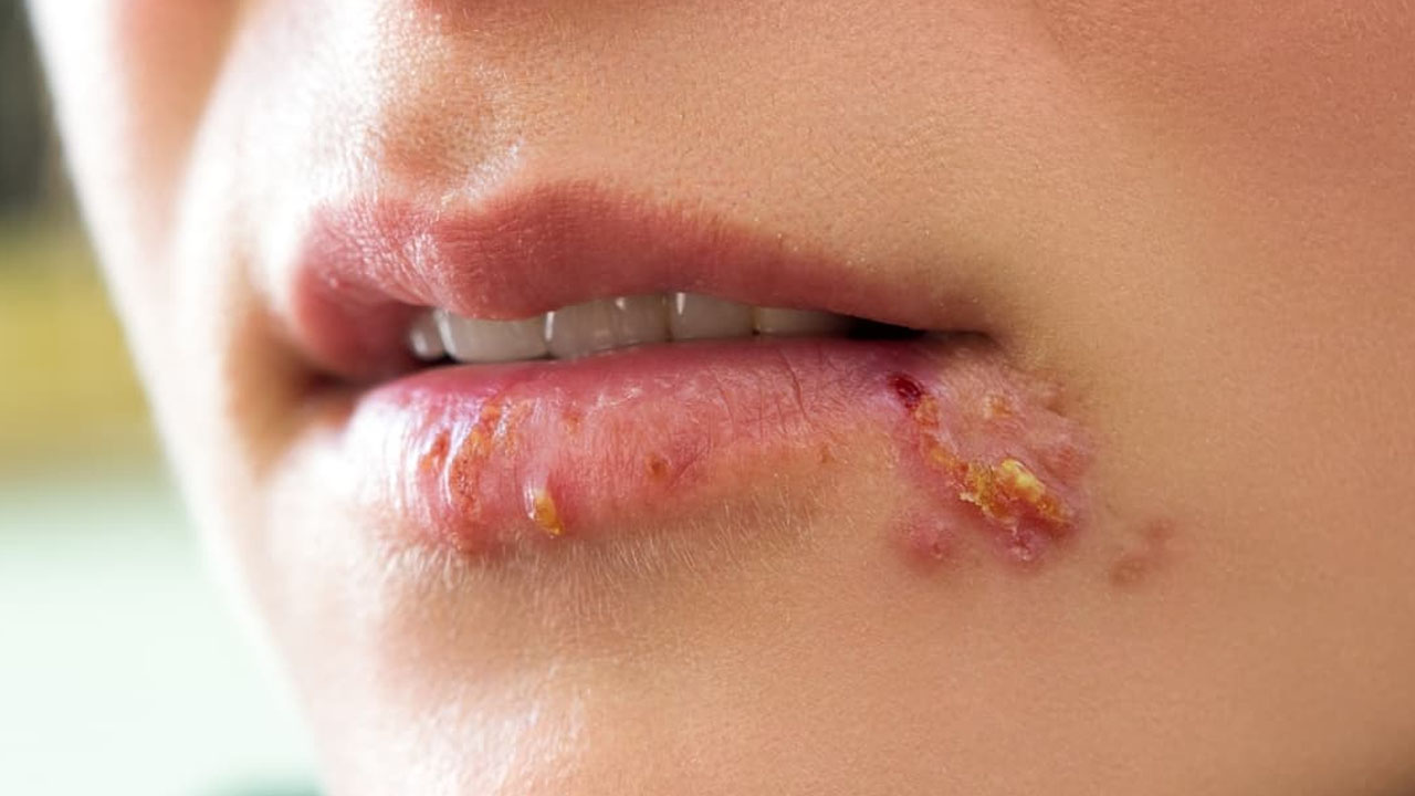 Foto - Uçuk virüsü tehlikesi ortaya çıktı! Bilim insanları gerçek bu diyerek duyurdular!