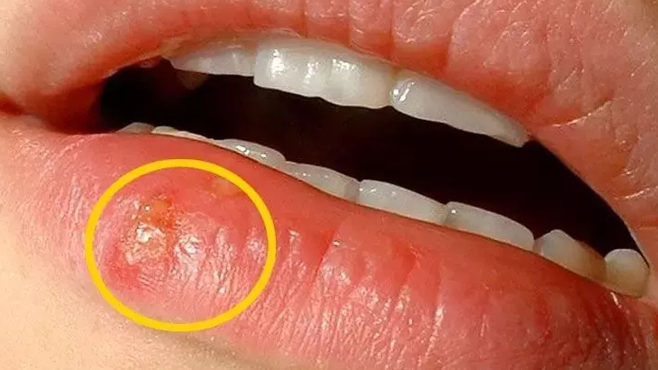 Foto - Uçuk virüsü tehlikesi ortaya çıktı! Bilim insanları gerçek bu diyerek duyurdular!