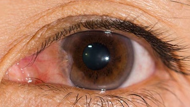 Foto - Ucuz güneş gözlüklerinin verdiği zararları öğrenince kullanmaya tövbe edeceksiniz!