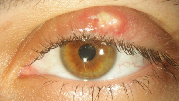 Foto - Ucuz güneş gözlüklerinin verdiği zararları öğrenince kullanmaya tövbe edeceksiniz!