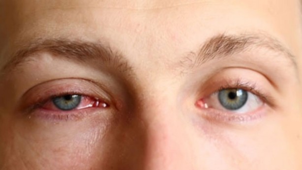 Foto - Ucuz güneş gözlüklerinin verdiği zararları öğrenince kullanmaya tövbe edeceksiniz!