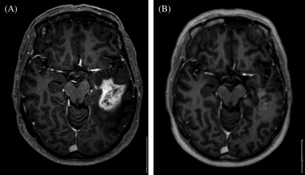 'Uluslararası Kanser Dergisi' yazdı! Ölümcül beyin tümörlerine karşı müthiş buluş